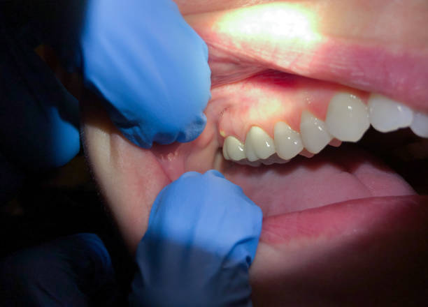 Best Tooth Infection Emergency Dentist  in Oak Harbor, WA
